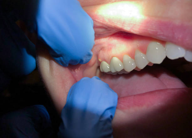 Best Emergency Treatment for Toothache in Country Clu, FL